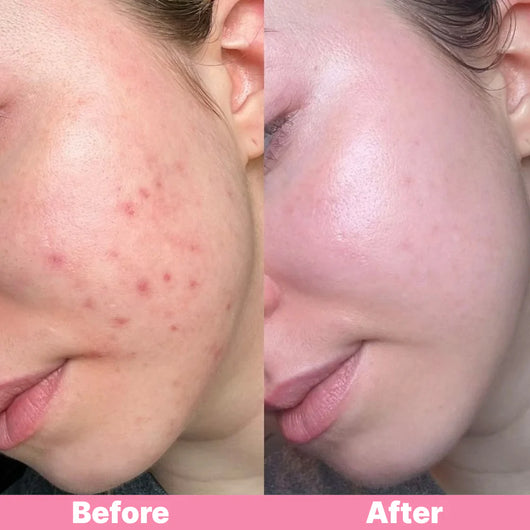 Osli Pimple Patch Roll