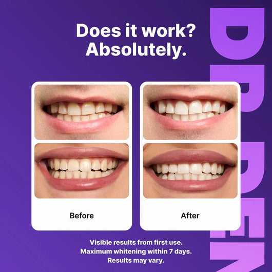 Osli Purple Teeth Whitening Strips