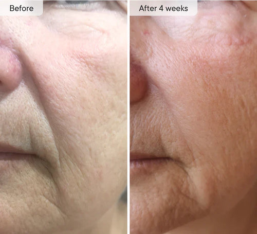 Osli Micro-Infusion Targeted Patches