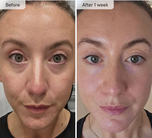 Osli Micro-Infusion Targeted Patches