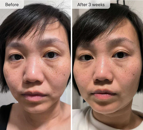 Osli Micro-Infusion Targeted Patches